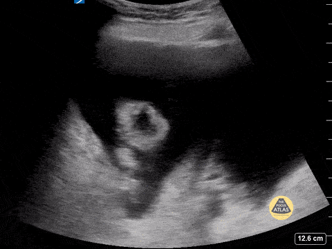 Peds-Gastrointestinal - Ascites