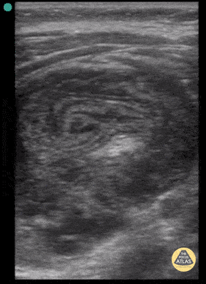 Peds-Gastrointestinal - Pseudokidney Sign - Intussusception