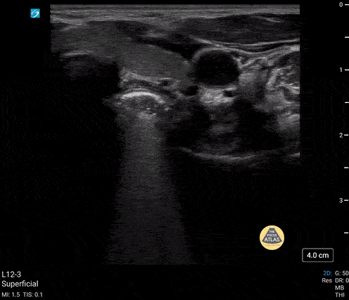 Peds-Gastrointestinal - Esophageal FB