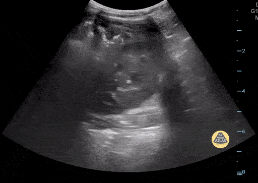 Peds-Gastrointestinal - Neuroblastoma