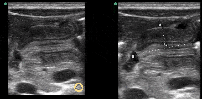 Peds-Gastrointestinal - Pyloric Stenosis 1