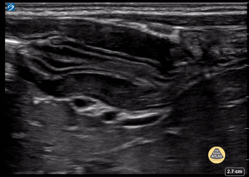 Peds-Gastrointestinal - Pyloric Stenosis 2 (1/2)