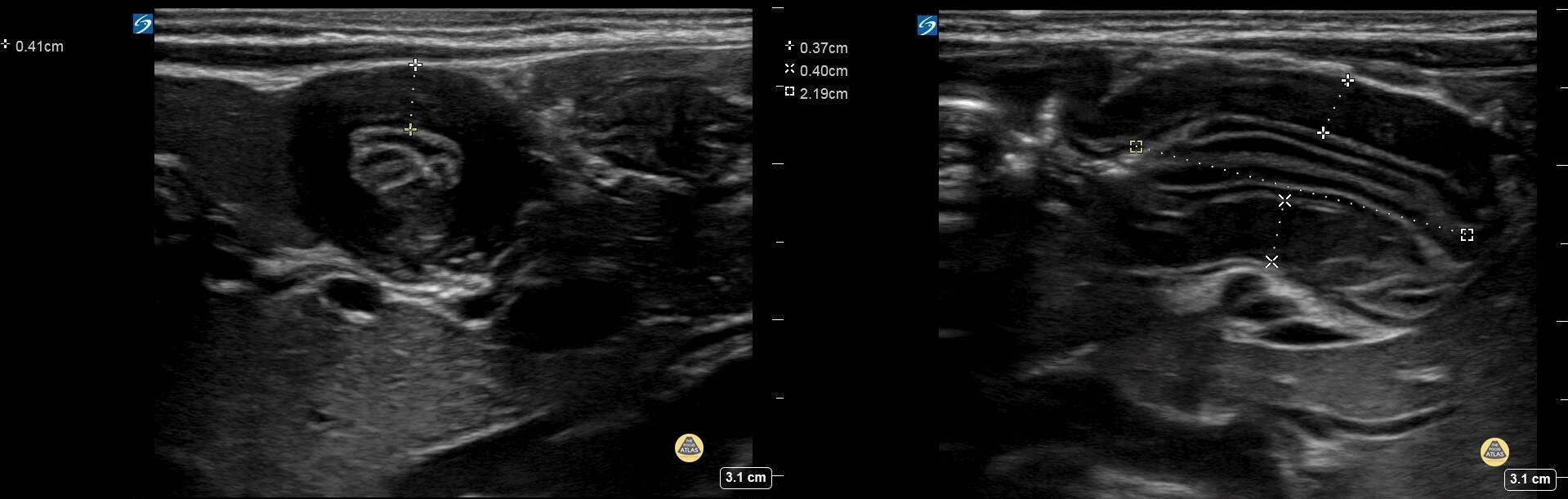 Peds-Gastrointestinal - Pyloric Stenosis 2 (2/2)