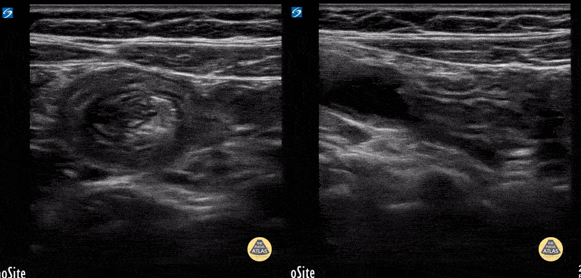 Peds-Gastrointestinal - Ileo-ileal intussusception