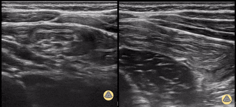 Peds-Gastrointestinal - Ileo-ileal Intussuception 2