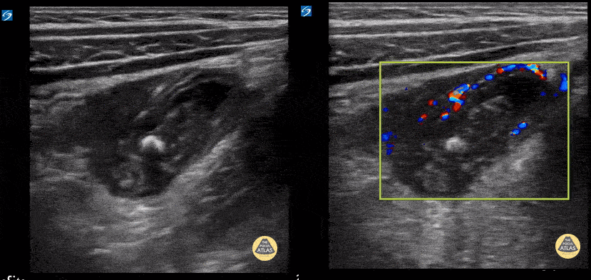 Peds-Gastrointestinal - Ruptured Appendicitis