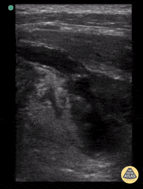 Peds-Gastrointestinal - Ruptured Appendicitis 2