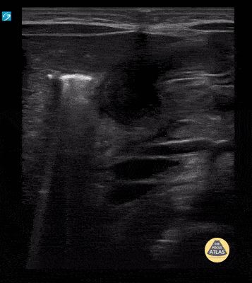 Peds-Gastrointestinal - Pyloric Stenosis with and without measurements (1/4)
