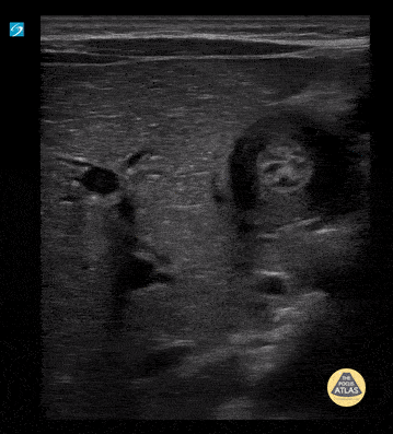 Peds-Gastrointestinal - Pyloric Stenosis with and without measurements (2/4)
