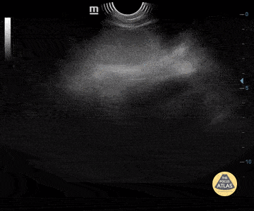 Peds-Gastrointestinal - Dengue Ascites