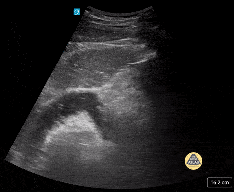 Peds-Gastrointestinal - SBO