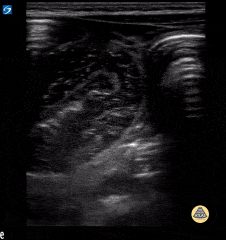 Peds-Gastrointestinal - SBO