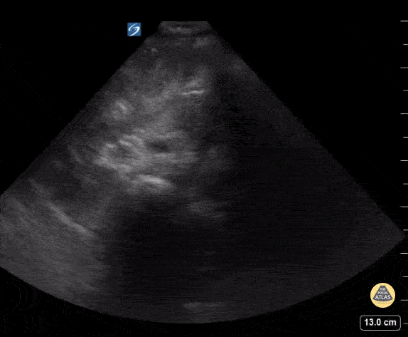 Peds-Biliary - Gallbladder Sludge