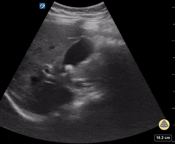 Peds-Biliary - Cholelithiasis with Stone in Neck