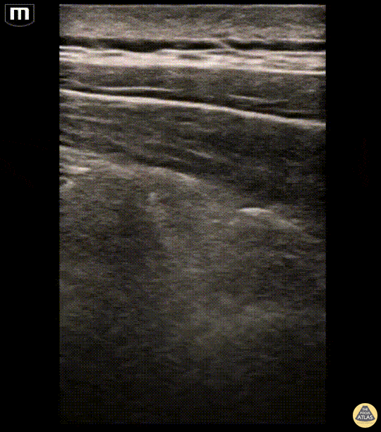 Nerve Block Gallery - Erector Spinae Block for a Traumatic Injury