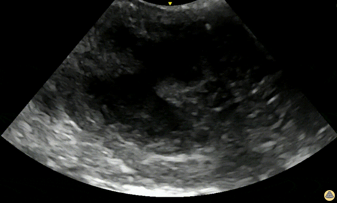 Soft Tissue - Peritonsillar Abscess with Posterior Color Flow