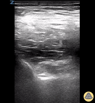 Nerve Block Gallery - PENG Block