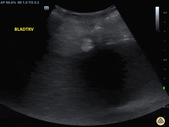 Renal/GU - Penile Prosthesis Reservoir