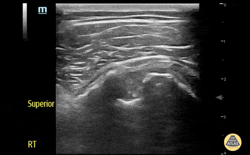 Musculoskeletal - Biceps long head tendon rupture, transverse view