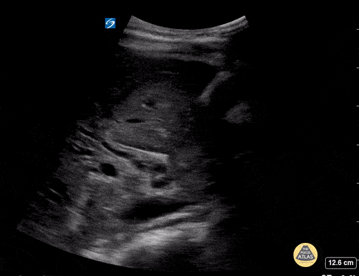Peds-Biliary - Dilated Common Bile Duct - B-Mode (1/3)