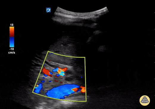 Peds-Biliary - Dilated Common Bile Duct - Color Doppler (2/3)