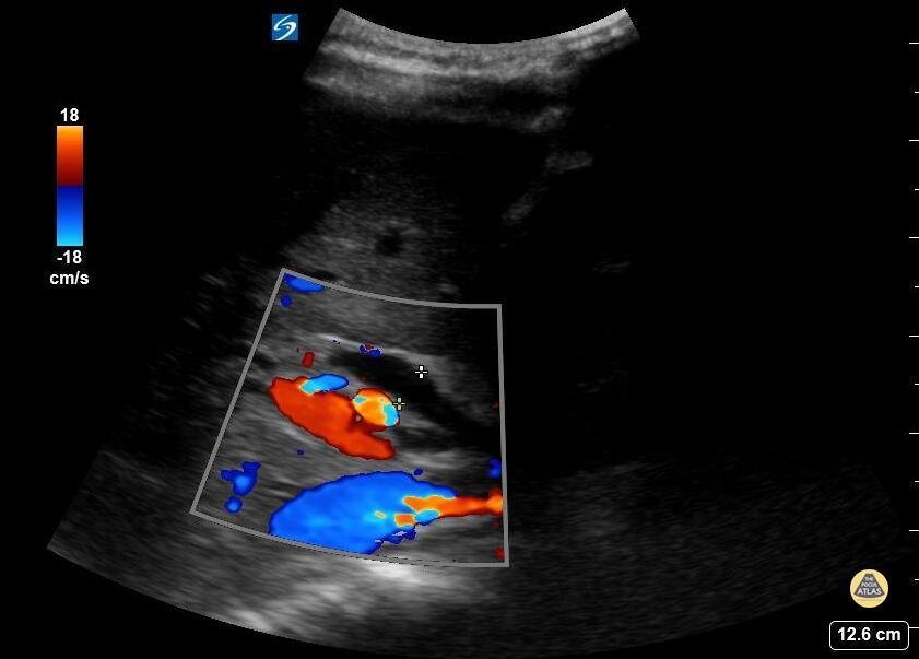 Peds-Biliary - Dilated Common Bile Duct - Measurement (3/3)