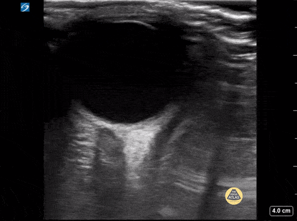 Peds-Orbital - Normal ONSD