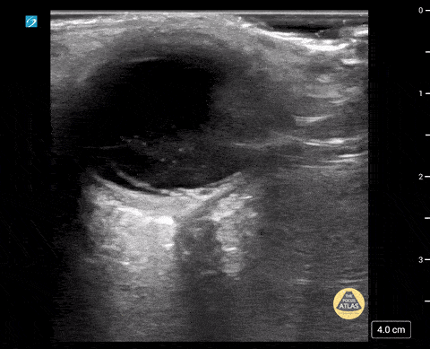 Peds-Orbital - Vitreous Hemorrhage/Macular Detachment