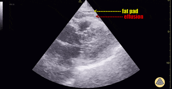 Pericardial Disease - Pericardial Effusion Vs Fat Pad [1/2]