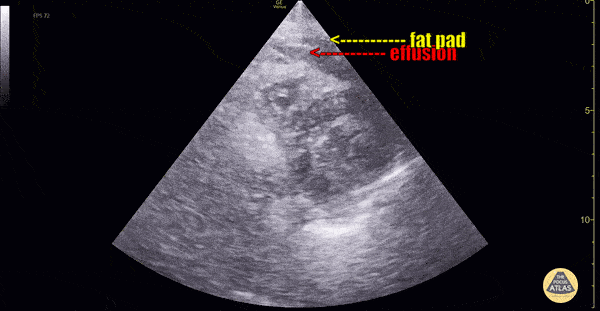 Pericardial Disease - Pericardial Effusion Vs Fat Pad [2/2]