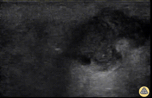 Soft Tissue - Soft Tissue Air in Necrotizing Fasciitis