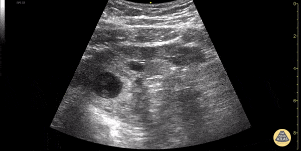 OB/Gyn - Ectopic Pregnancy