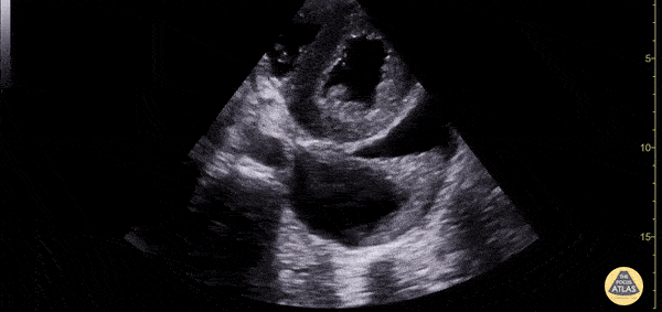 Pericardial Disease - Pericardial and Pleural Effusion In PSSA