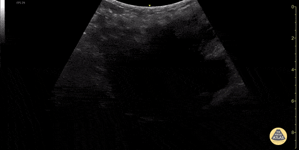 OB/Gyn - Uterus with Leiomyomas (fibroids)