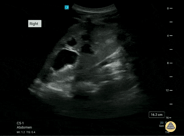 Renal/GU - Moderate-Severe Hydronephrosis