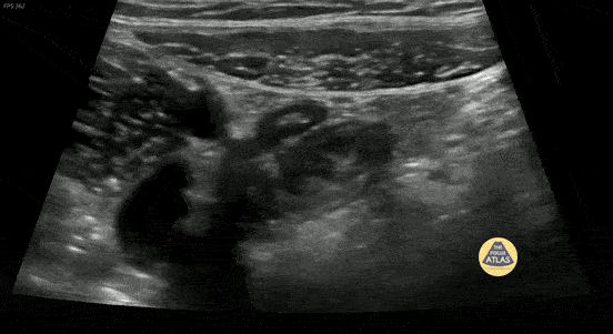 Peds-Gastrointestinal - Normal Appendix 1 (1/3)
