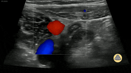 Peds-Gastrointestinal - Normal Appendix 1 (2/3)
