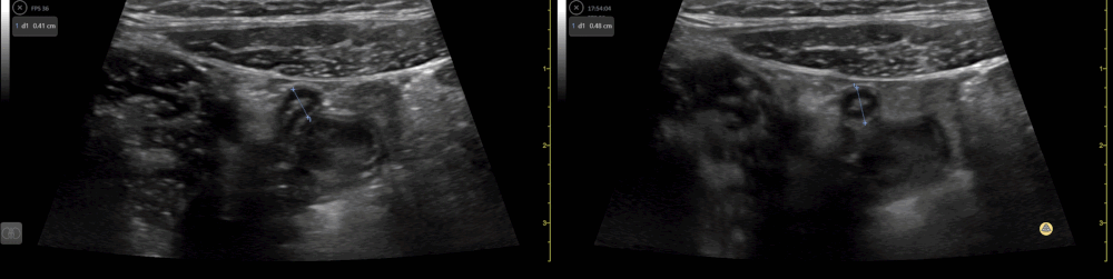 Peds-Gastrointestinal - Normal Appendix 1 (3/3)