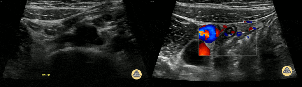 Peds-Gastrointestinal - Normal Appendix 2 (1/2)
