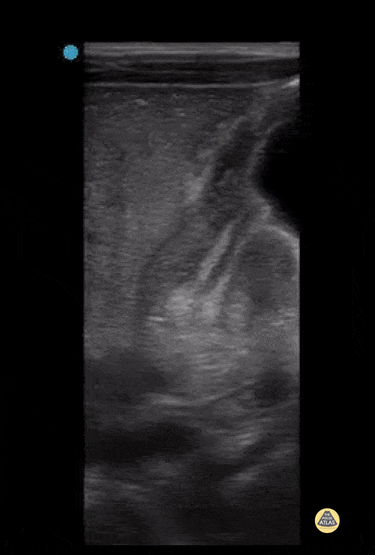 Peds-Gastrointestinal - Pyloric Stenosis - Antral Nipple Sign