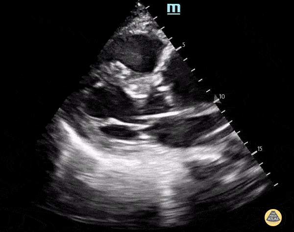 Thoracic Aortic Dissection & Aneurysm - Ascending Thoracic Aortic Aneurysm