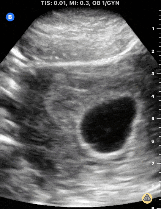 OB/Gyn - Fetal Pole with Cardiac Activity