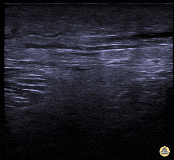 Soft Tissue - Subcutaneous Air in Necrotizing Fasciitis
