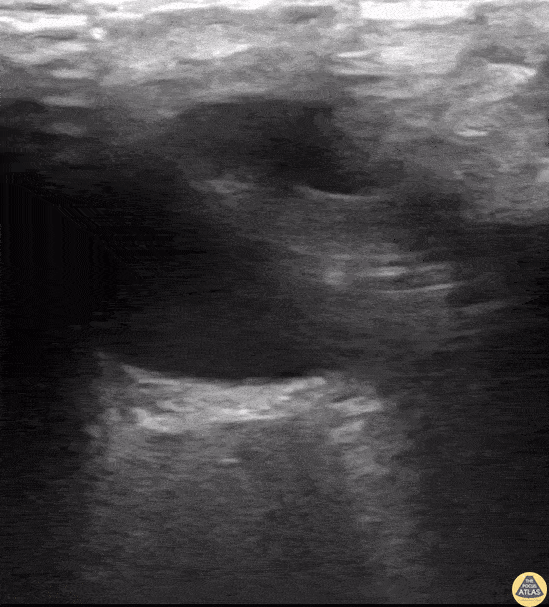 Orbital - Papilledema From Optic Pathway Glioma