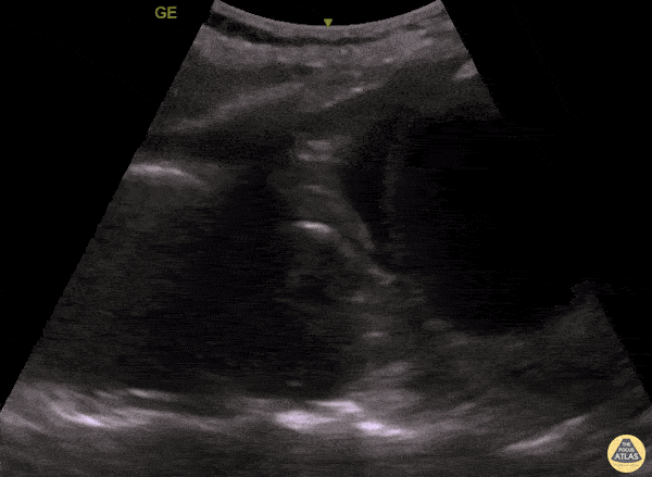 Aorta - Thoracic Aortic Aneurysm Rupture Seen on PLAPS View