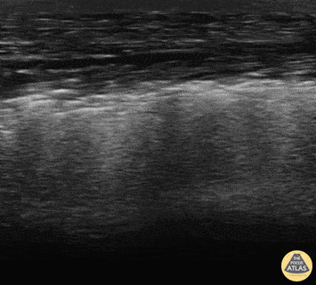 Soft Tissue - NEC Fas at Elbow Joint