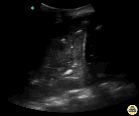 Pulmonary - Massive dynamic air bronchogram