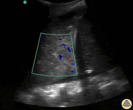 Pulmonary - Color Doppler of Consolidation in Pneumonia