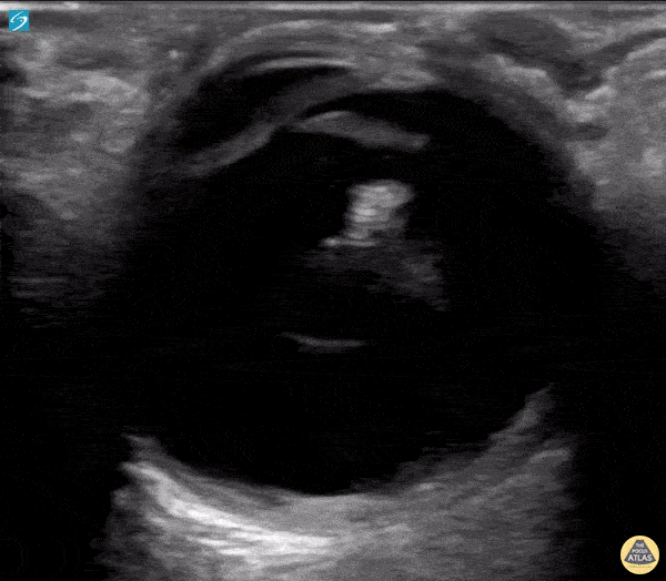 Orbital - Intraoccular Lens Subluxation