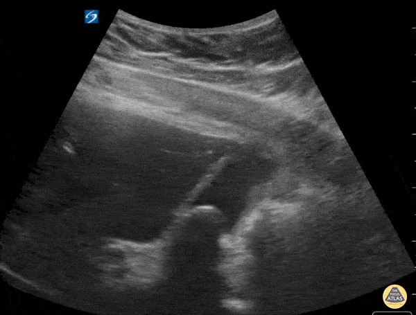 Peds-Biliary - Large Gallstone